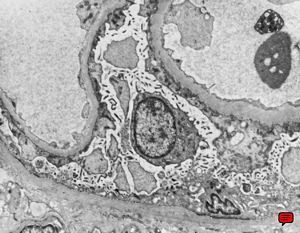 F,70y. | nephrotic syndrome: minimal changes - fusion of pedicles F,70y. | nephrotic syndrome: minimal changes - fusion of pedicles